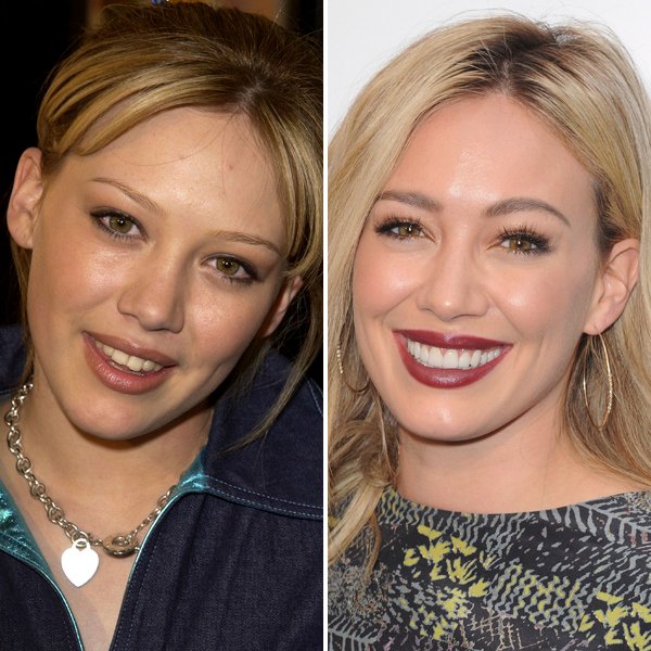 Hilary duff teeth