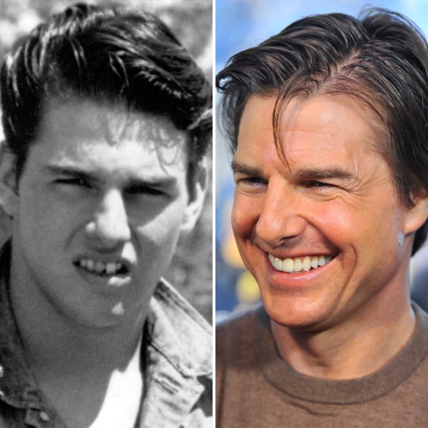Tom cruise teeth
