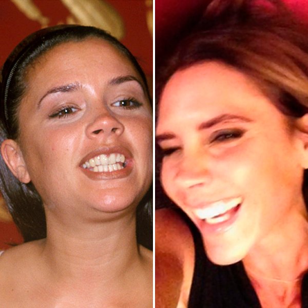 Victoria beckham teeth