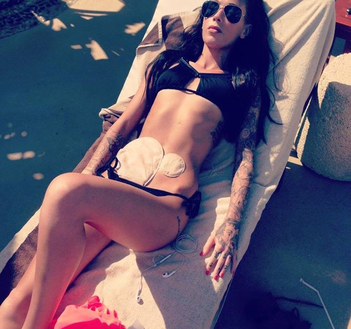 Model poses colostomy bag bikini