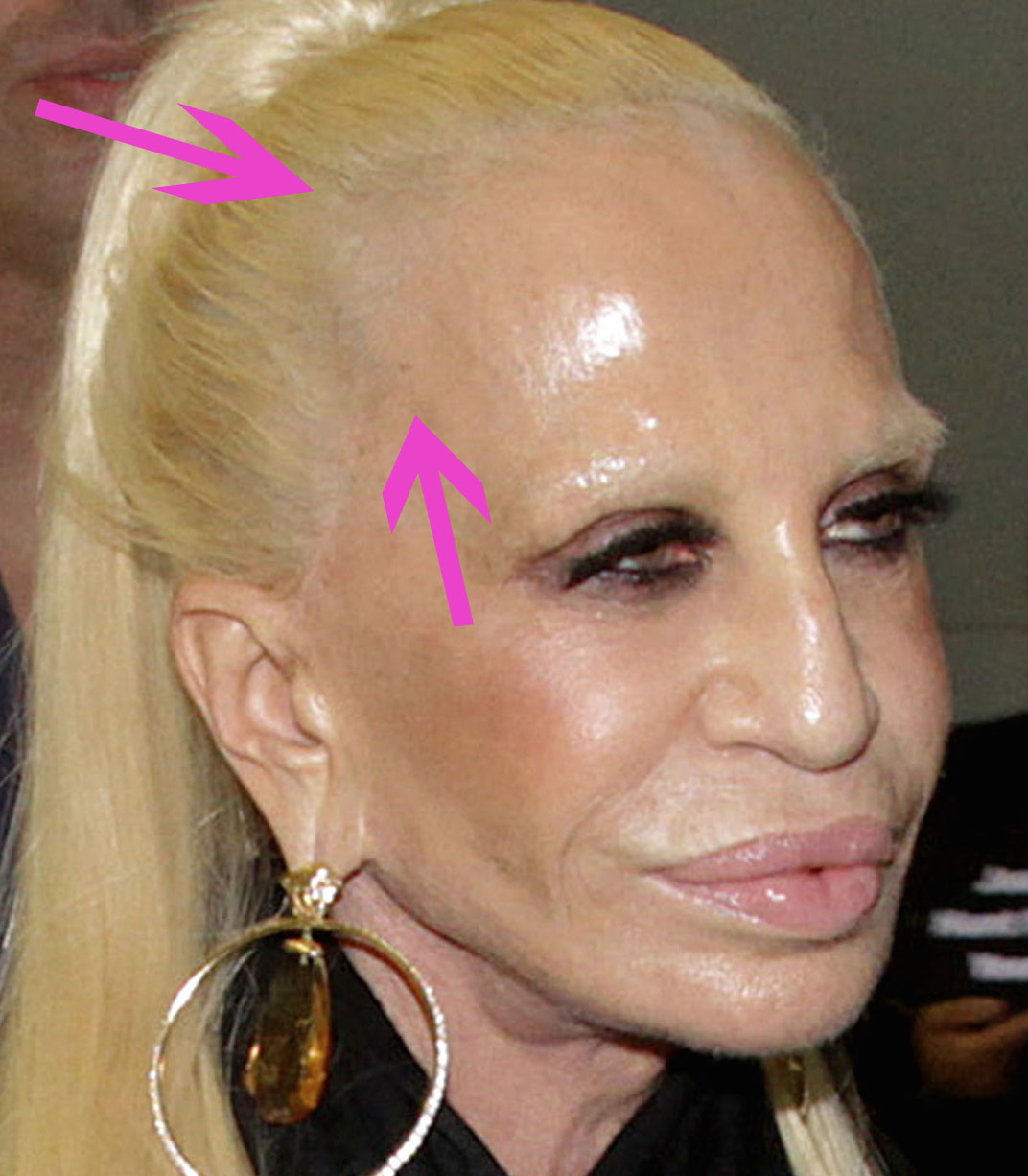donatella plastic surgery face