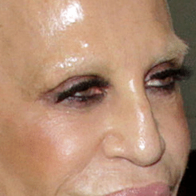 donatella plastic surgery face