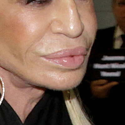donatella plastic surgery face