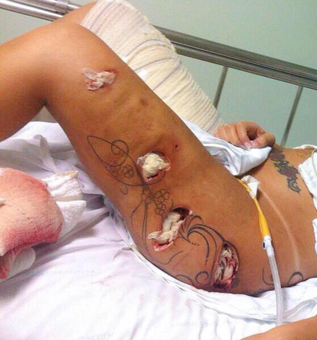 butt model plastic surgery