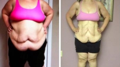 Plastic surgeon skin removal surgery weight loss