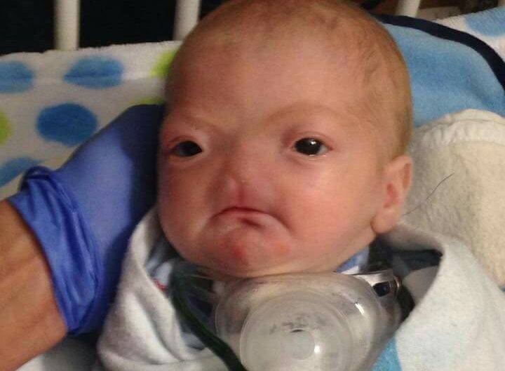 Baby born without nose 7