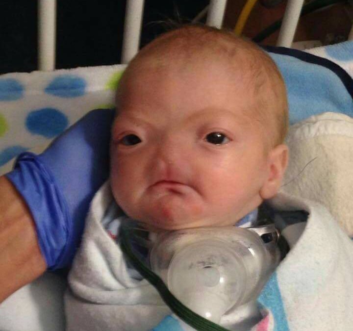 Baby born without nose 7