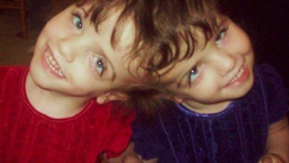 Conjoined twins