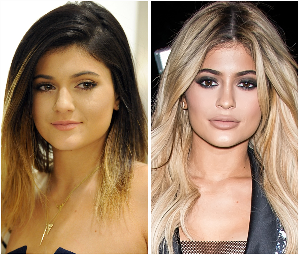Plastic Surgeons Urge Kylie Jenner To Stop With The