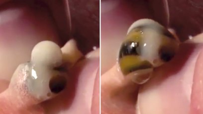 Snail in knee