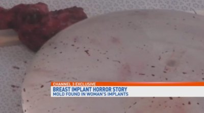moldy breast implants