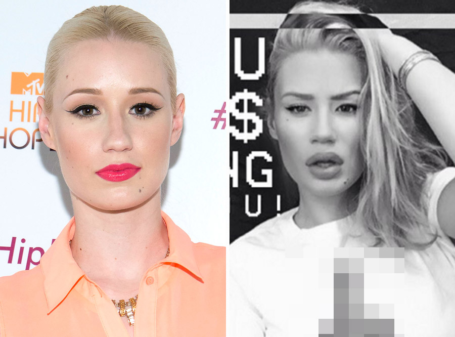 Iggy azalea lip injections