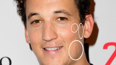 Miles teller scar