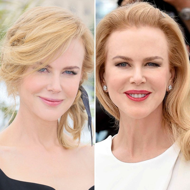 Nicole kidman plastic surgery