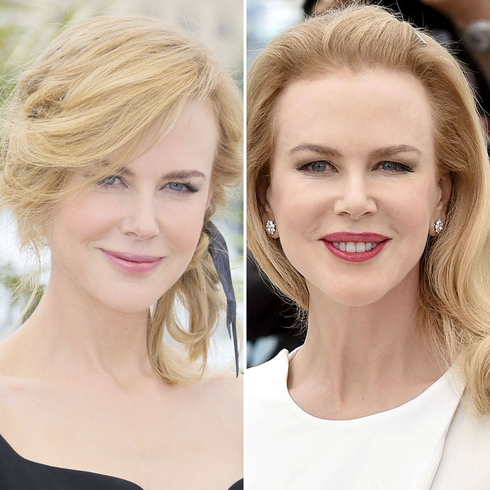 Nicole kidman plastic surgery