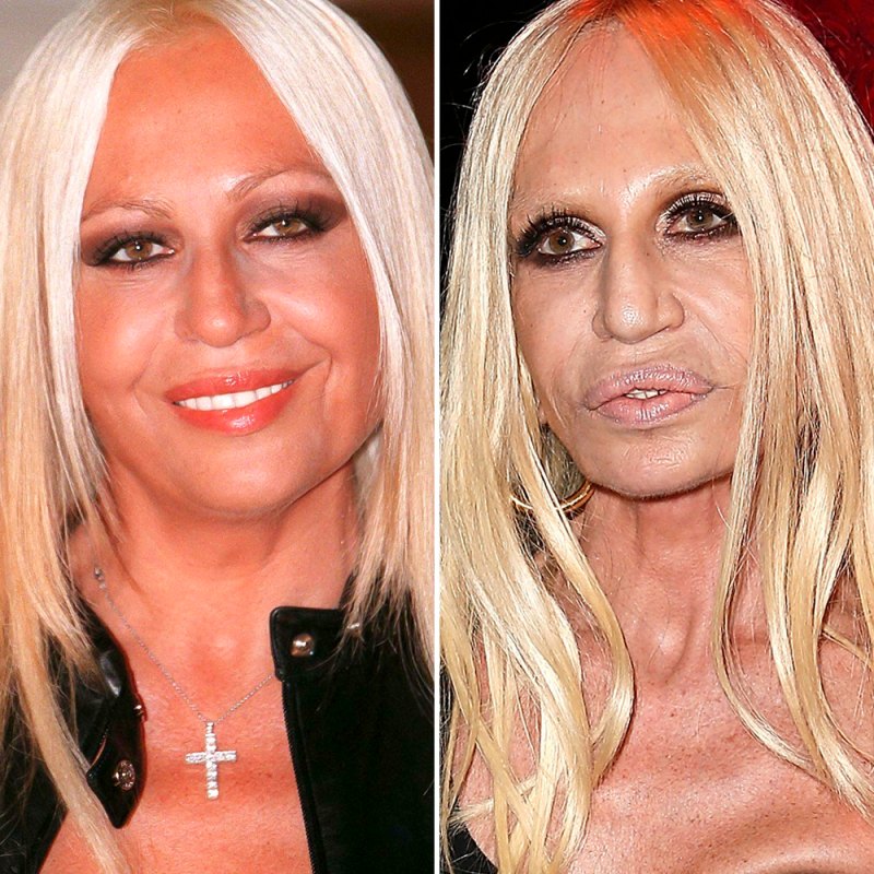Plastic surgery donatella versace copy