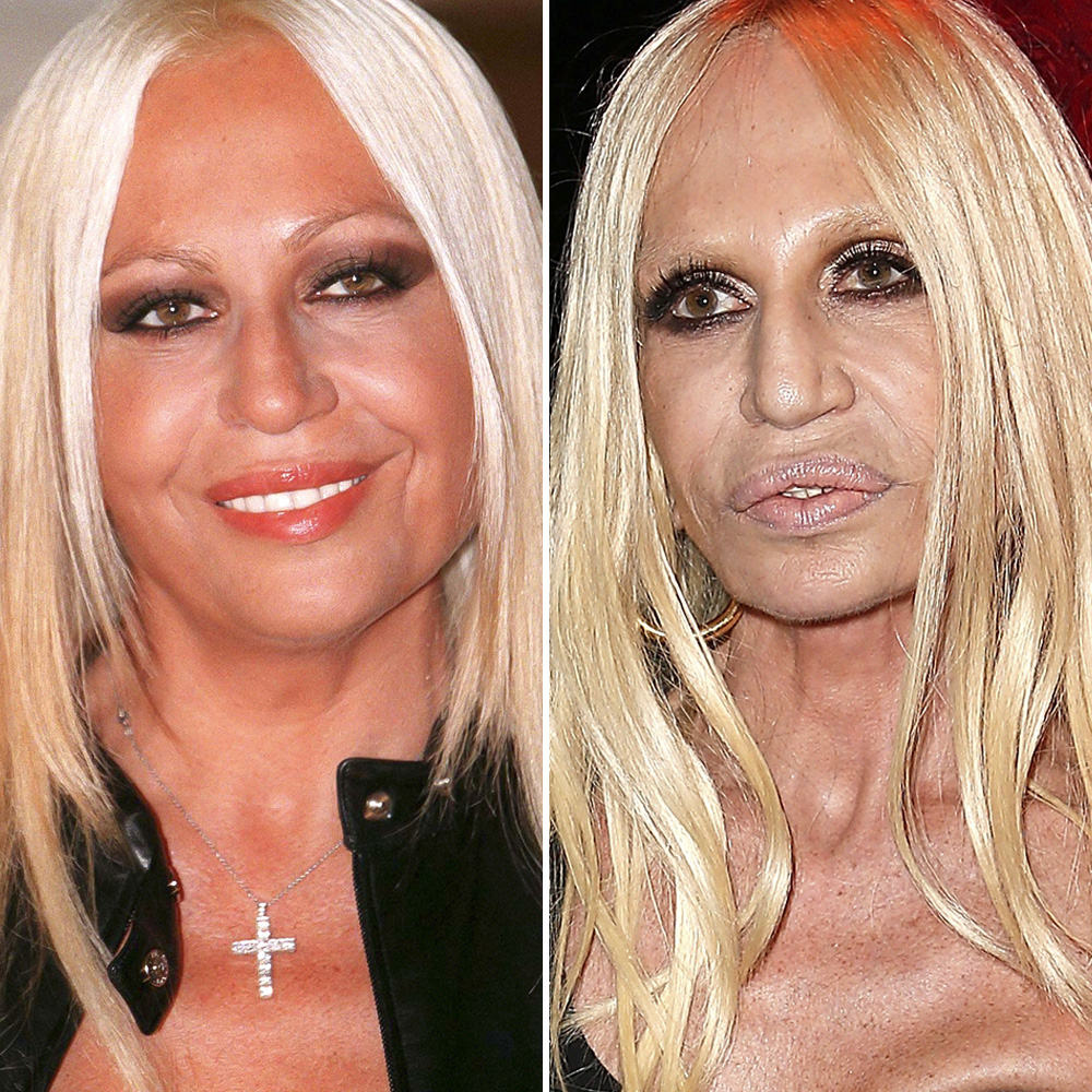 Plastic surgery donatella versace copy