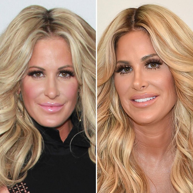 Plastic surgery kim zolciak