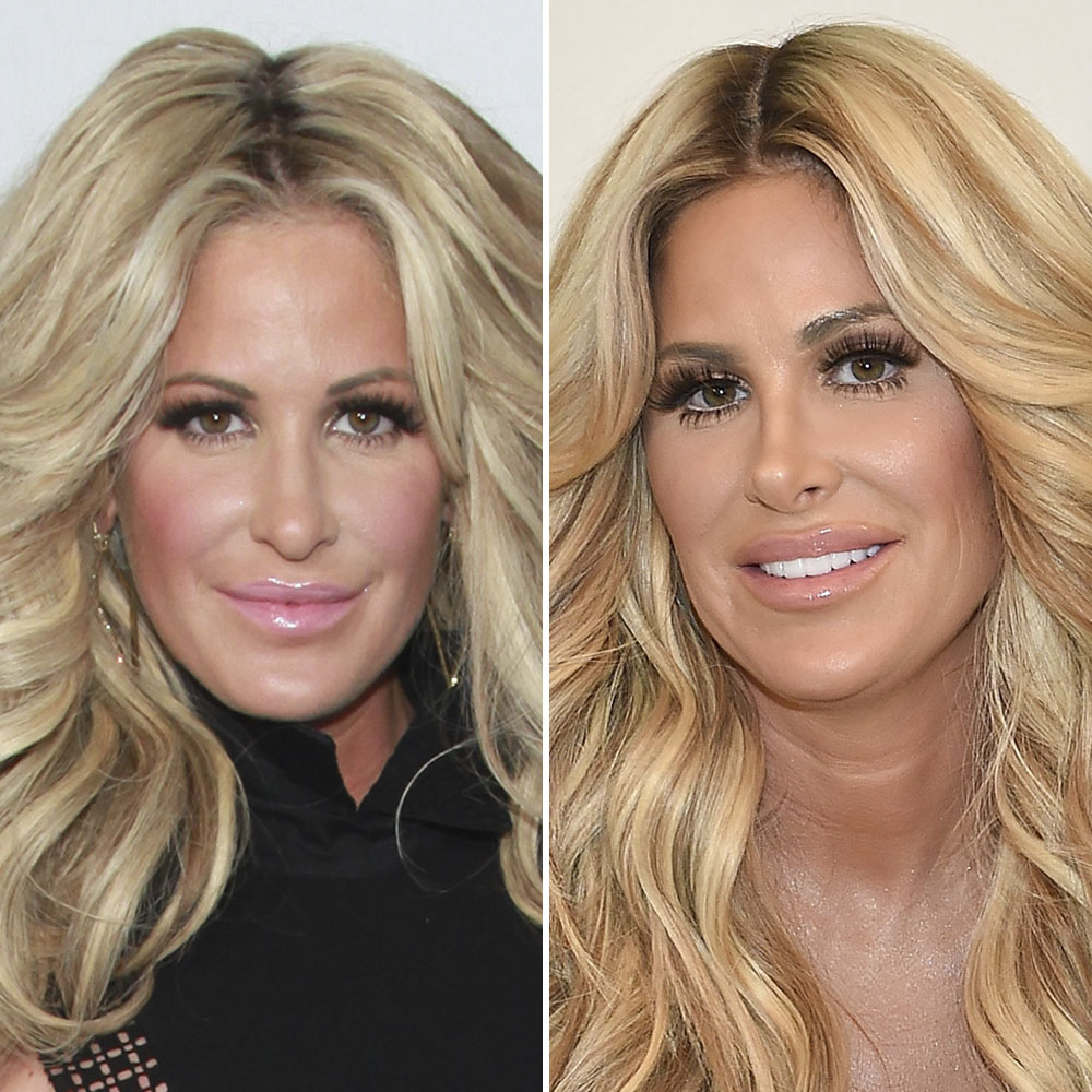Plastic surgery kim zolciak