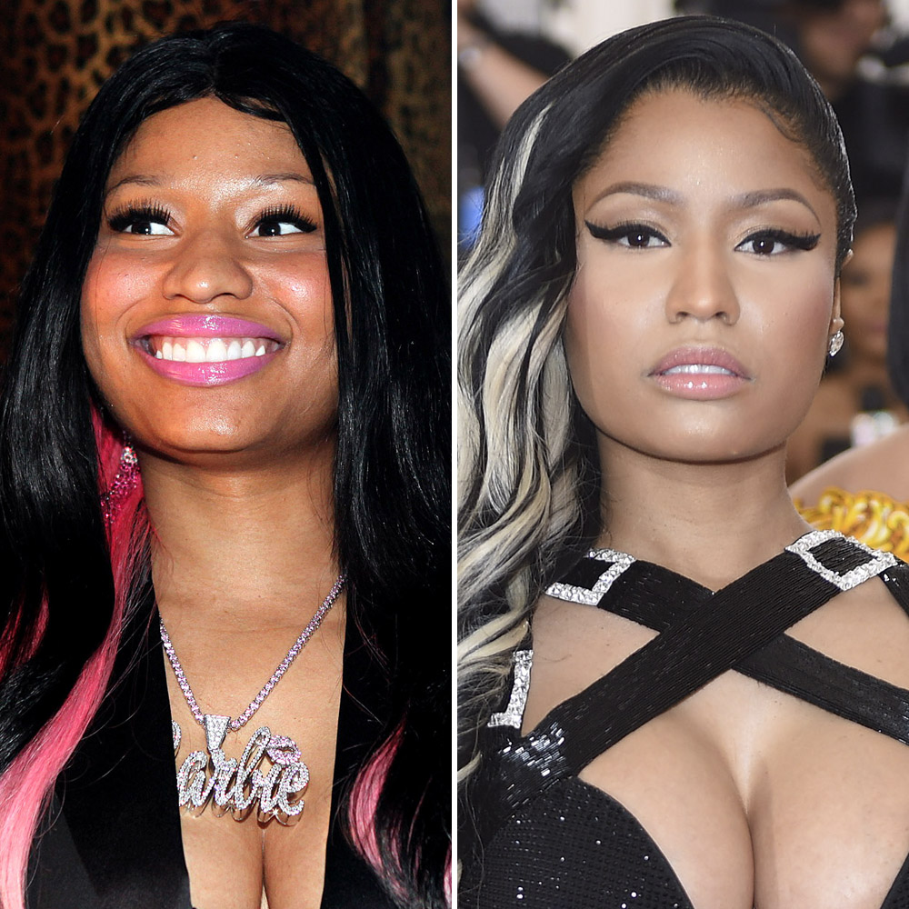 Plastic surgery nicki minaj