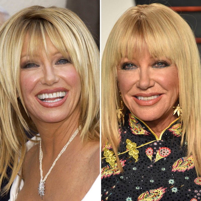 Plastic surgery suzanne somers copy