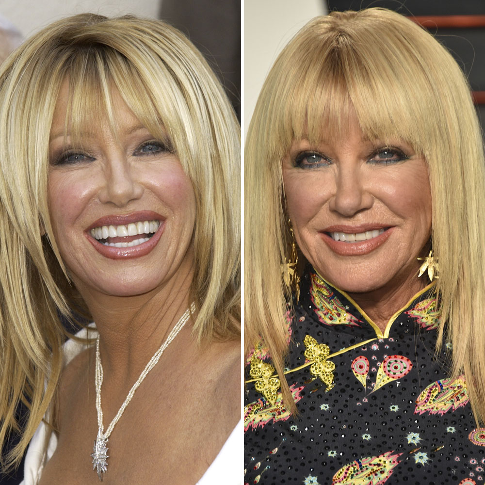 Plastic surgery suzanne somers copy