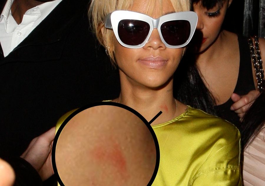 Black Girl Hickey - Kim Kardashian, Rihanna, and More Stars Who've Been Spotted With Hickies on  Their Necks - Life & Style