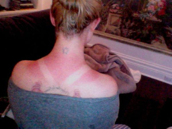 Kelly osbourne sunburn