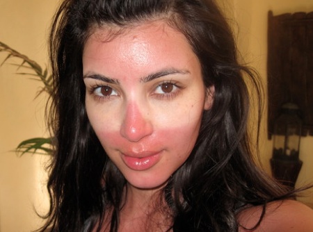 Kim kardashian sunburn
