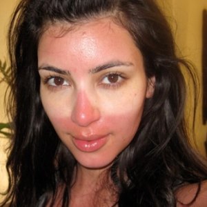 Kim kardashian sunburn