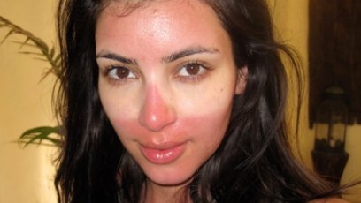 Kim kardashian sunburn