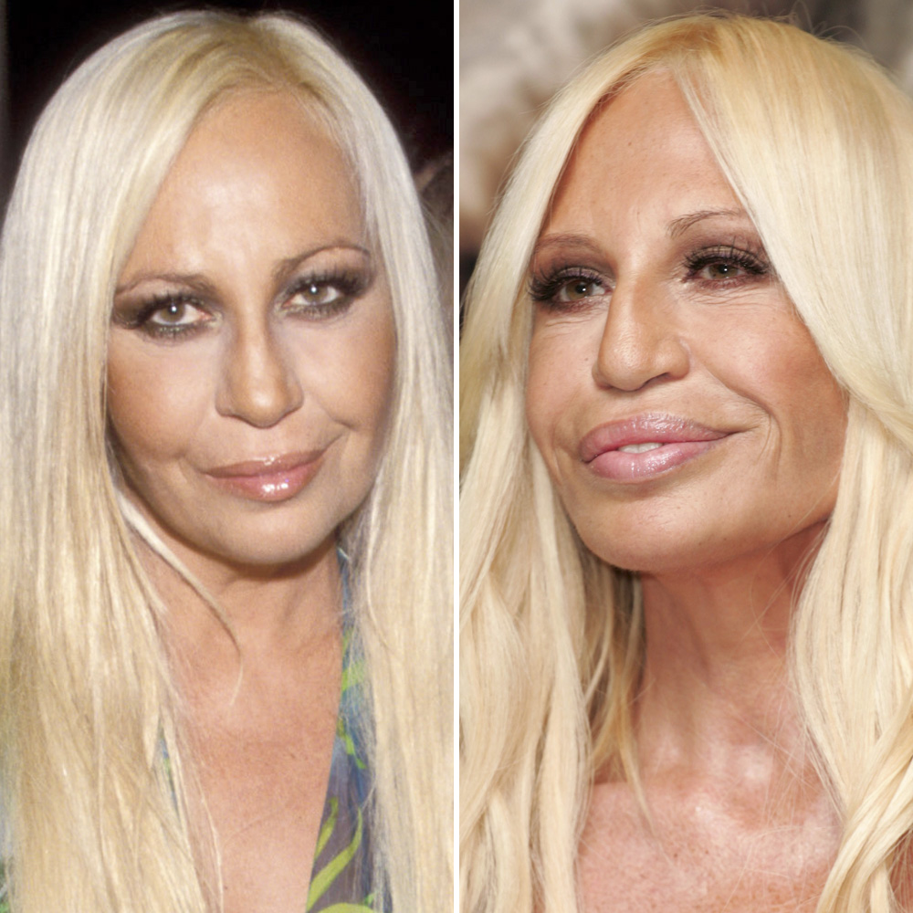 Donatella versace surgery