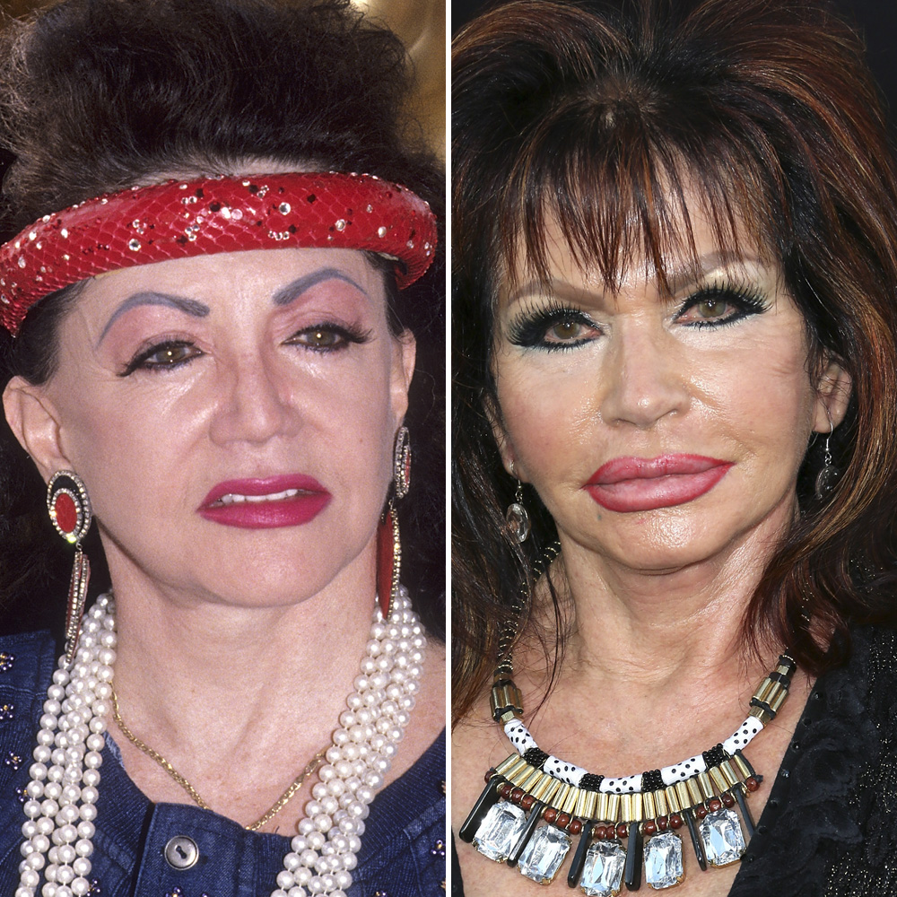 Jackie stallone surgery