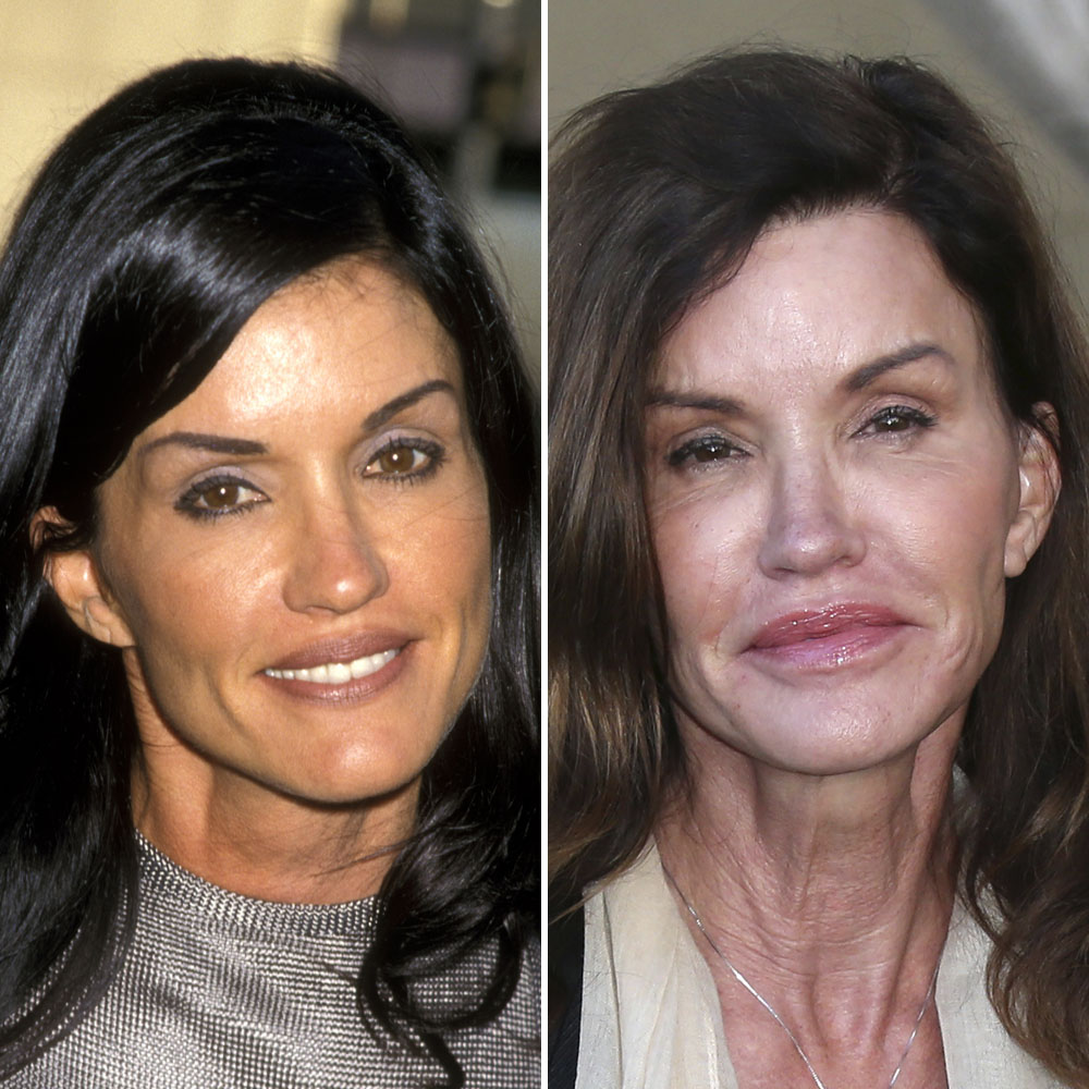 Janice dickinson surgery