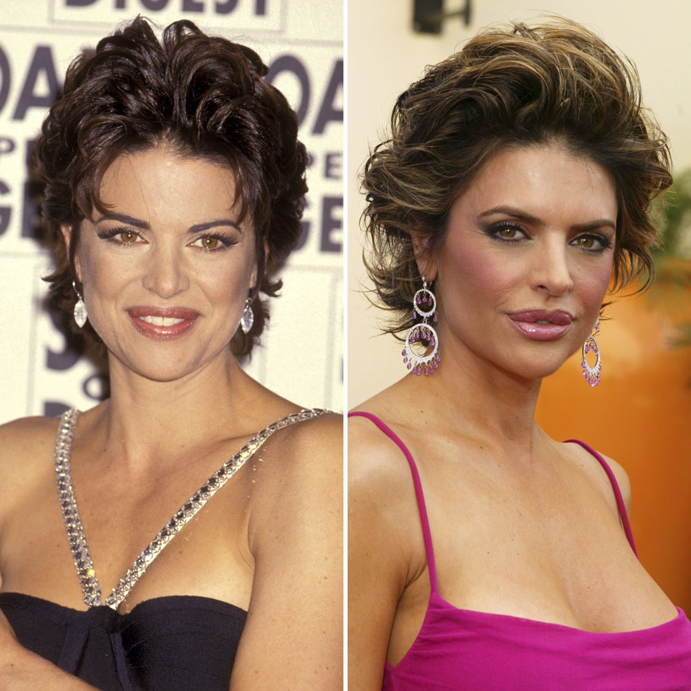 Lisa rinna surgery