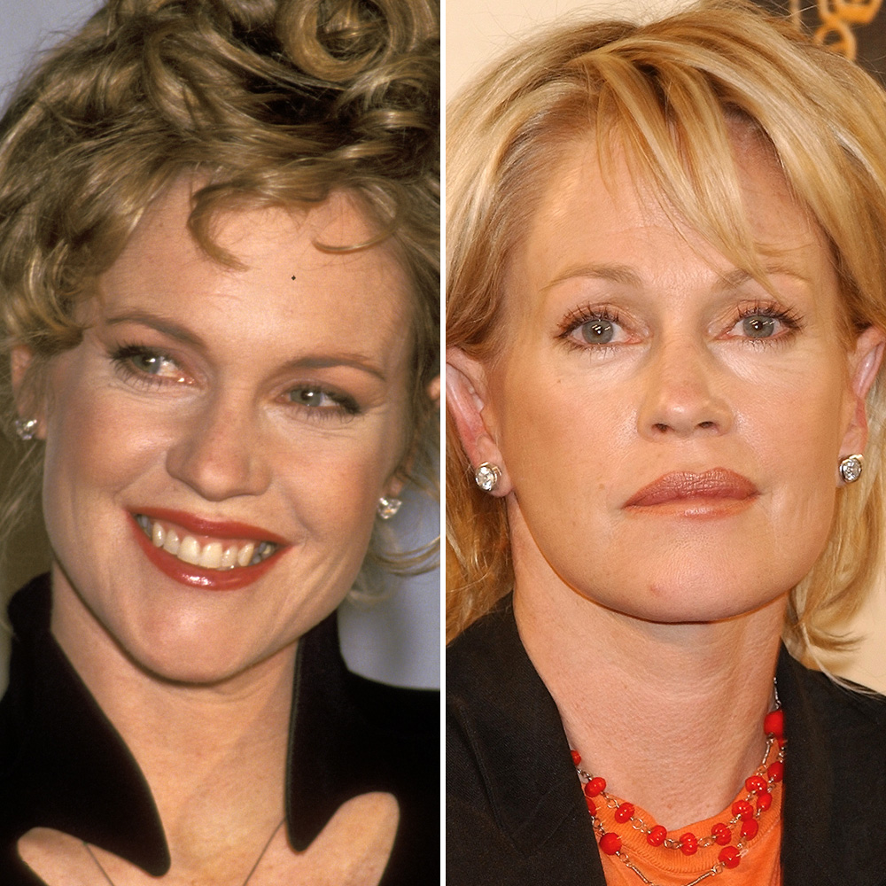 Melanie griffith surgery