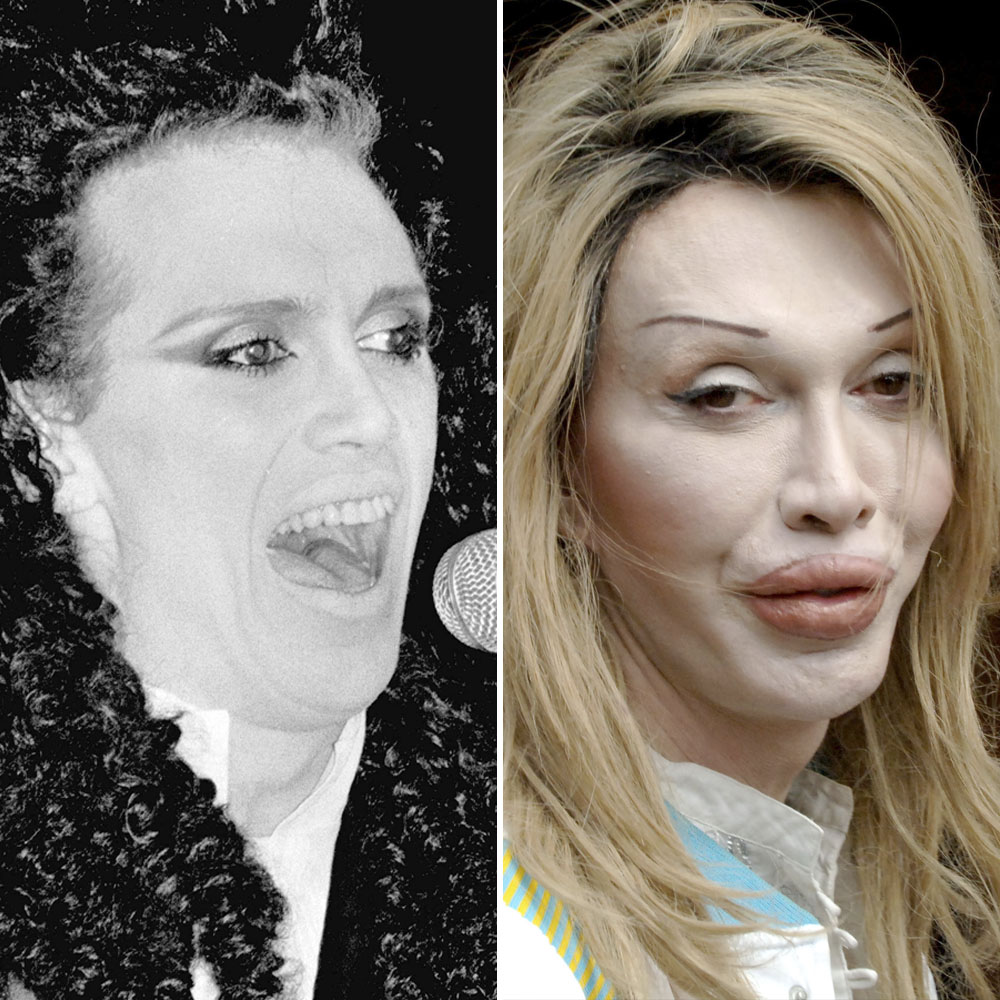 Pete burns surgery