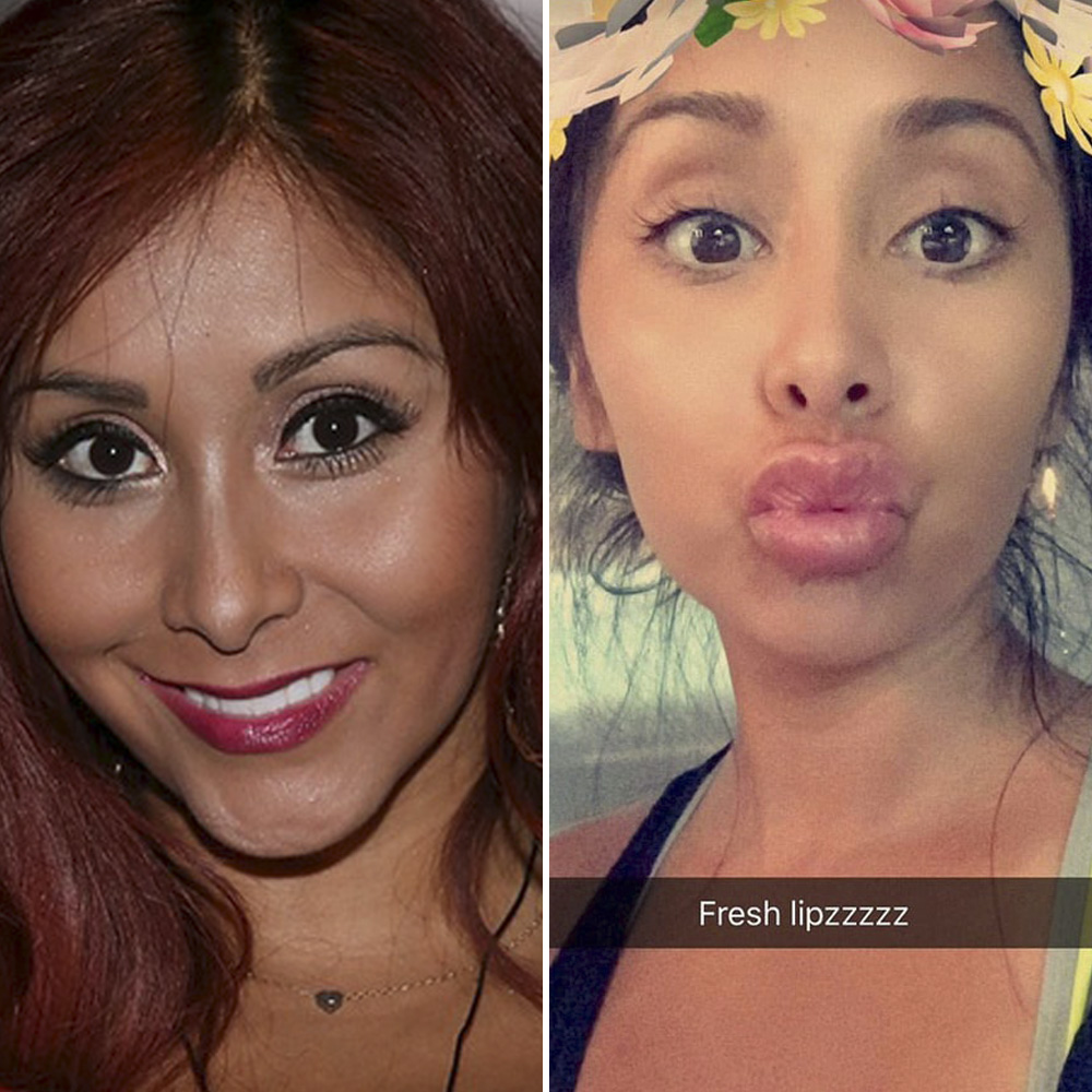 Snooki lip injection