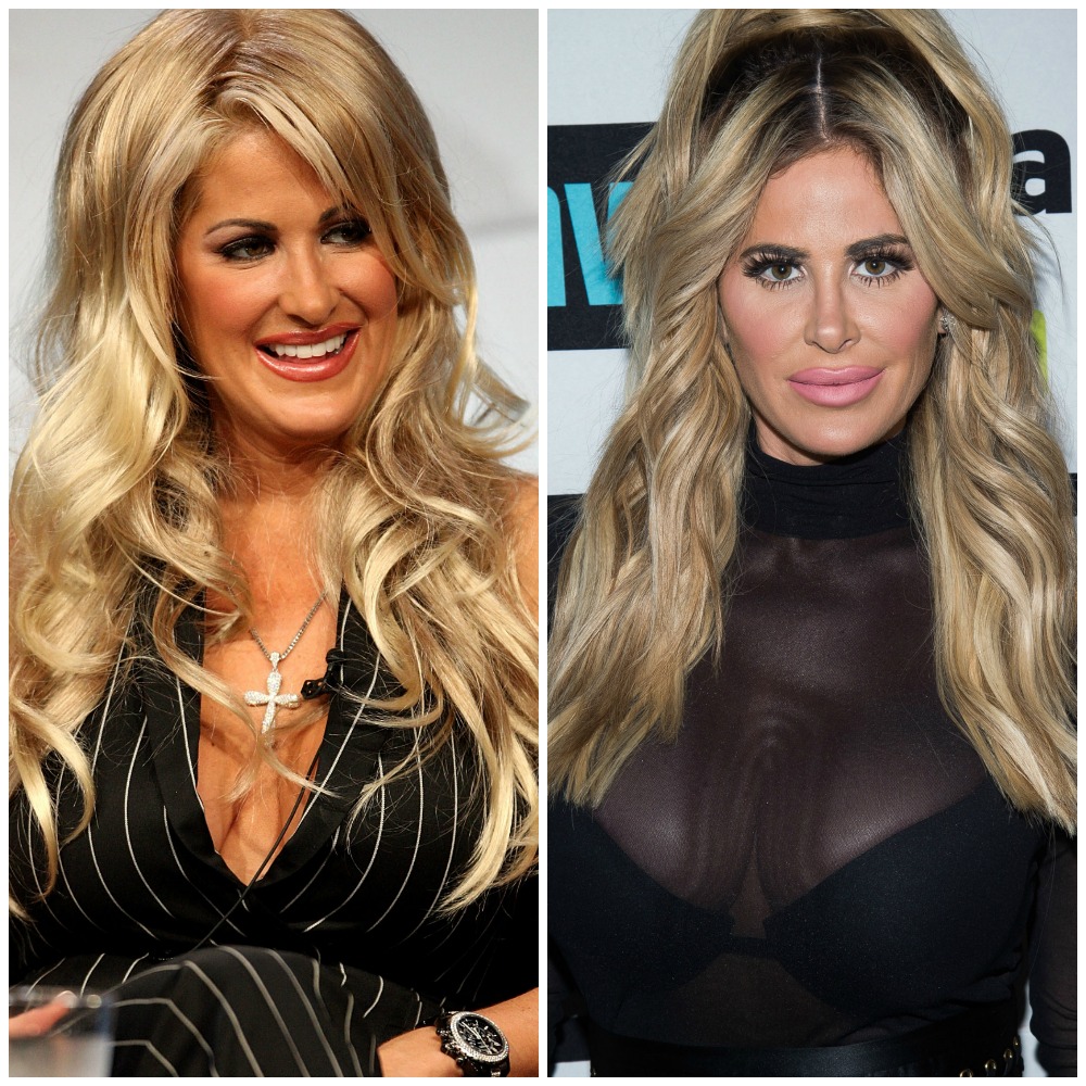 kim zolciak before and after tummy tuck