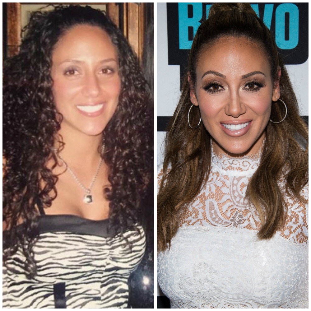 Housewives plastic surgery melissa gorga