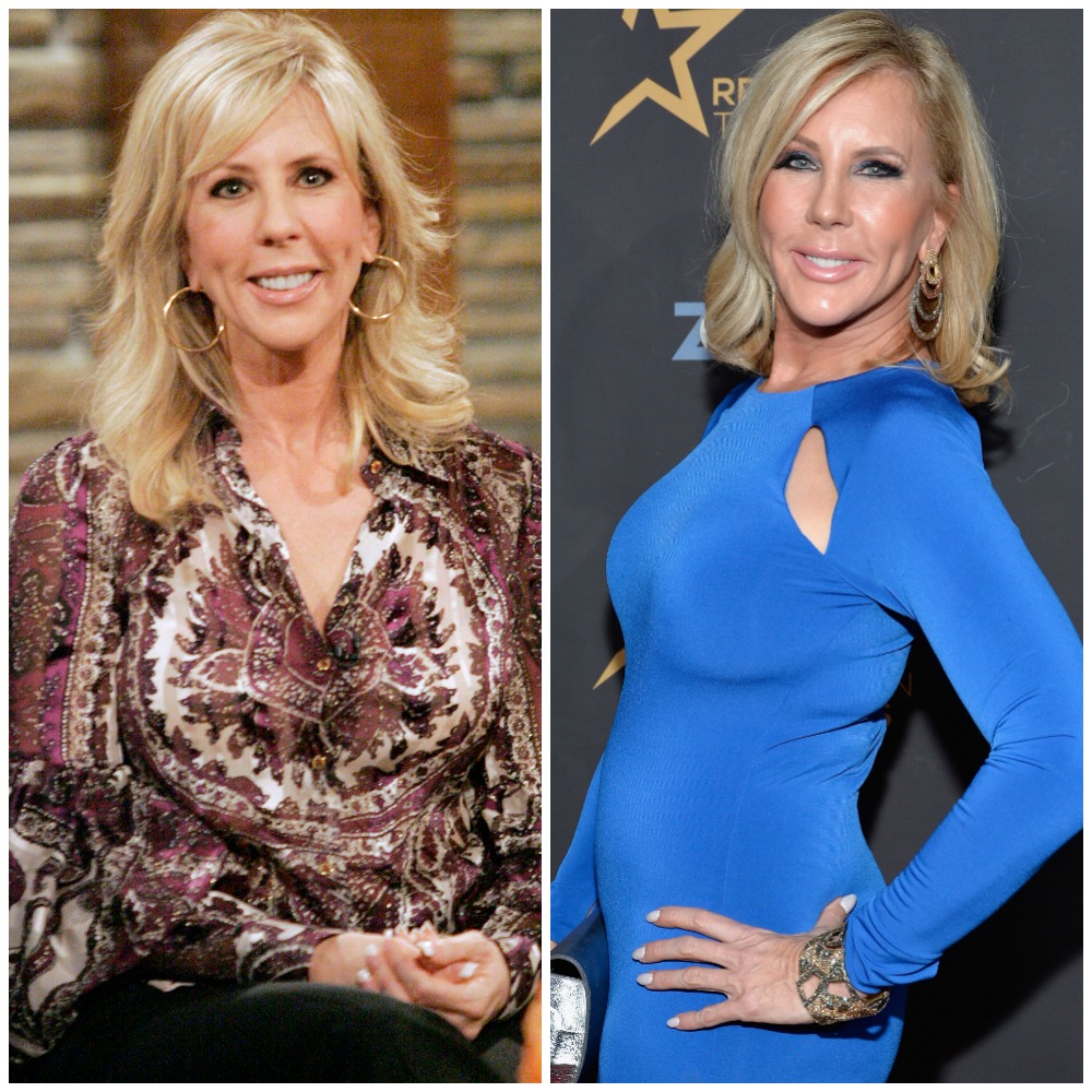 Housewives plastic surgery vicki gunvalson
