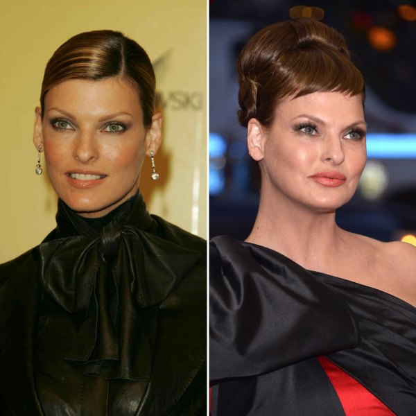 Celebs Who Have Admitted to Botched Plastic Surgery: Photos | Life & Style