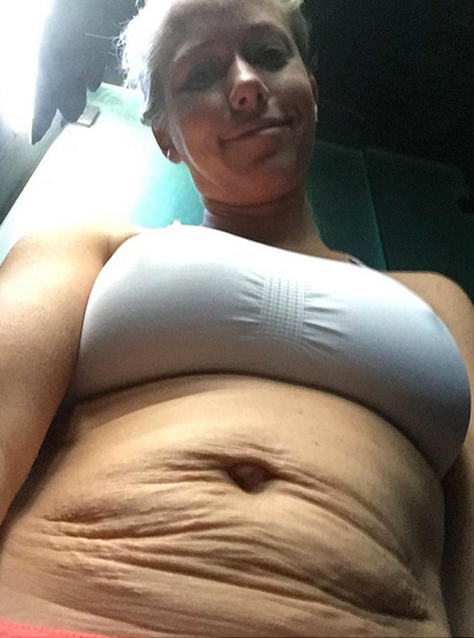 Kendra wilkinson stretch marks