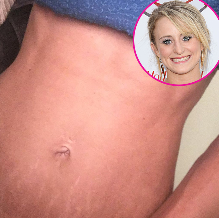 Leah messer stretch marks