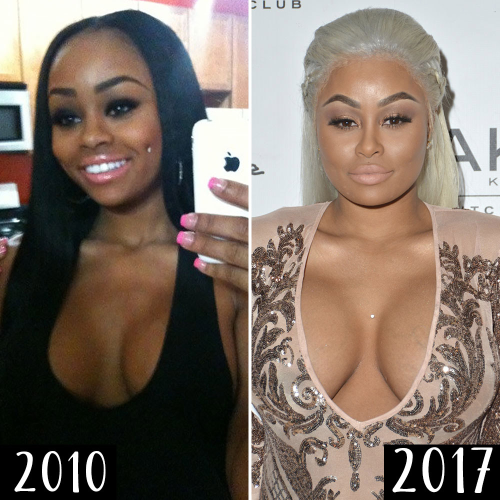 Did Blac Chyna Get Plastic Surgery? See What the Experts Say
