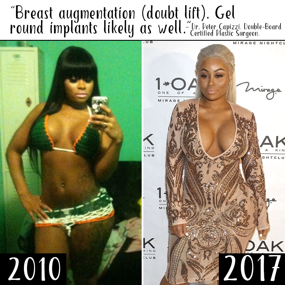 200px x 200px - Did Blac Chyna Get Plastic Surgery? See What the Experts Say