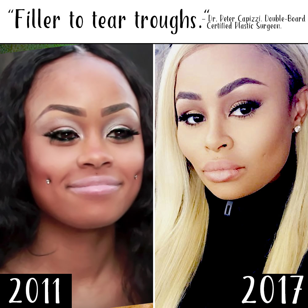 1000px x 1000px - Did Blac Chyna Get Plastic Surgery? See What the Experts Say