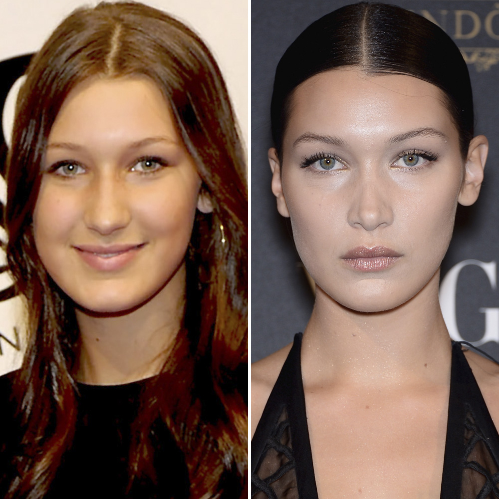 Bella hadid plastic surgery