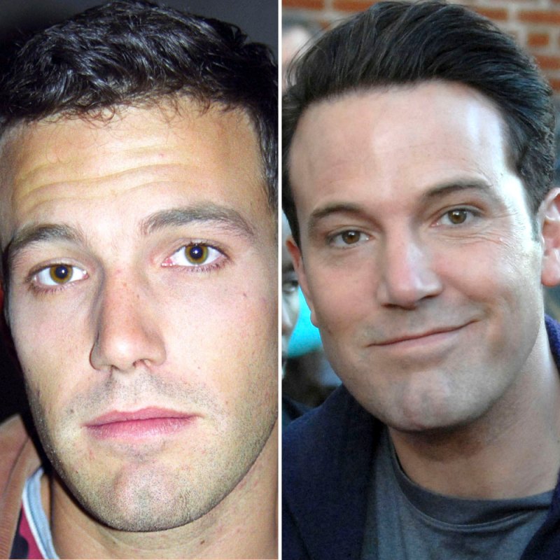 Ben affleck plastic surgery