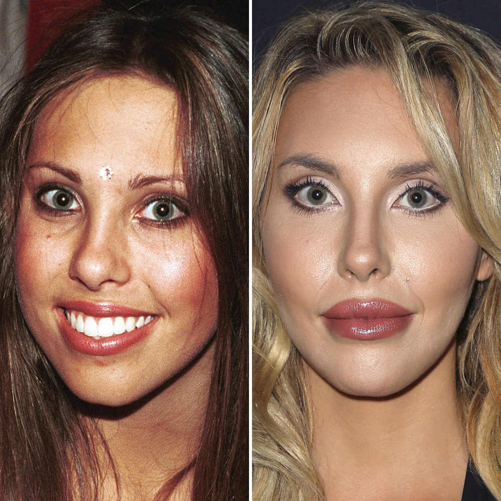 Chloe rose lattanzi plastic surgery